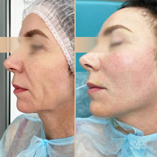 Подтяжка лица без операций и шрамов: коррекция кожи нитями Aptos
